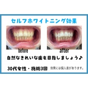 セルフホワイトニング効果♪
